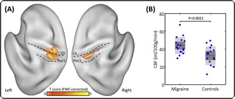 A Migraine Related Increase Of Rcbf In The Primary Somatosensory