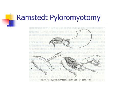 Ramstedt Pyloromyotomy