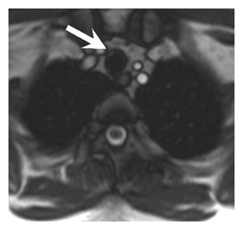 A 36 Year Old Woman With Adenoid Cystic Carcinoma A Ct And B Download Scientific Diagram