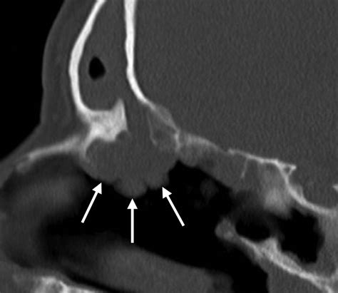 Failed Endoscopic Sinus Surgery Spectrum Of Ct Findings In The Frontal