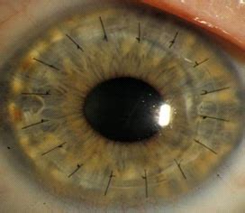 Cornea and Corneal Diseases - Lighthouse Guild