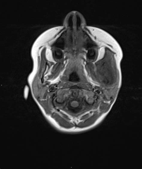 Chronic Reactive Multifocal Osteomyelitis Crmo Mandible Image