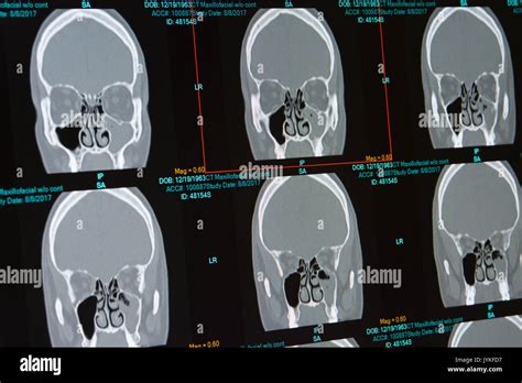 CT scan of male with sinus infection (sinusitis) filling the left ...