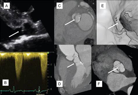 Clinmed International Library Ambiguous Left Ventricular Outflow