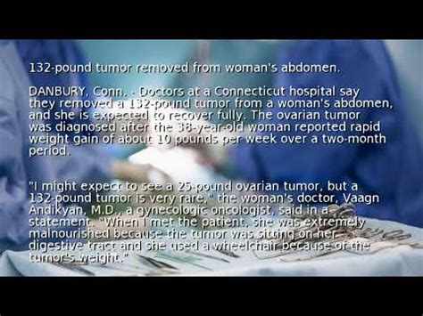 Pound Tumor Removed From Woman S Abdomen Youtube