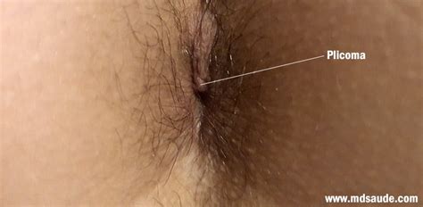 Plicoma Anal Pele No Nus O Que Riscos E Tratamento