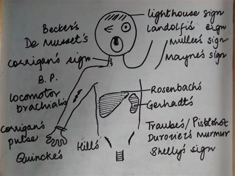 By Pulsatile Peripheral Signs In Aortic Regurgitation