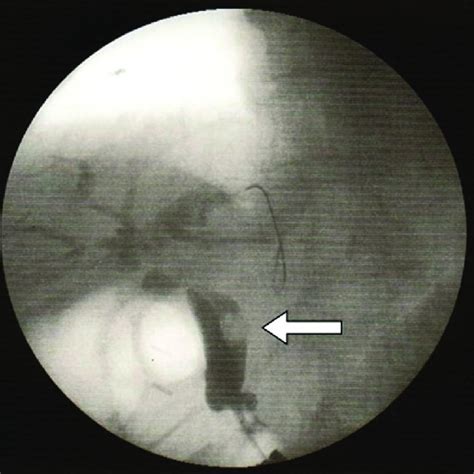 Endoscopic Views Of Common Bile Duct CBD Stone Removal By Using Only