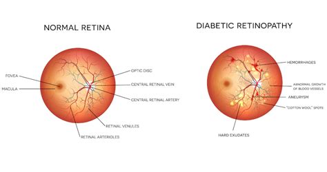 Diabetic Eye Disease Dr Monawwar Khan Specialist Ophthalmic Surgeon