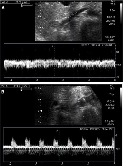 Right Nutcracker Syndrome Associated With Left Sided Inferior Vena Cava