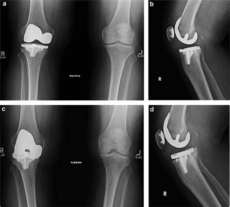 Follow Up Radiographs Obtained Approximately Months A B And