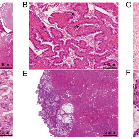 Histological Features Of Tumors Of Each Genital Tract A The Ovarian