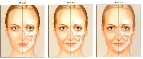 Understanding The Aging Face From The Triangle Of Youth To The Pyramid