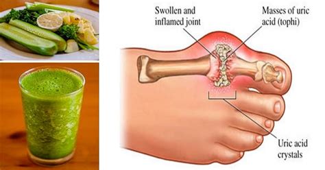 Easy Ways To Remove Uric Acid From Your Joints Healhty And Tips