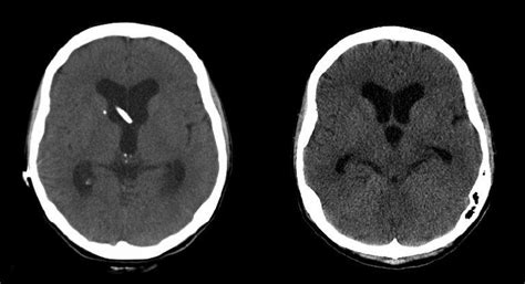 Shunt Removal Procedures | Pacific Adult Hydrocephalus Center