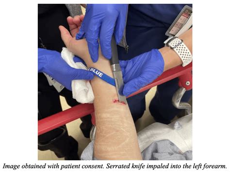emDOCs.net – Emergency Medicine EducationEM@3AM: Impaled Objects