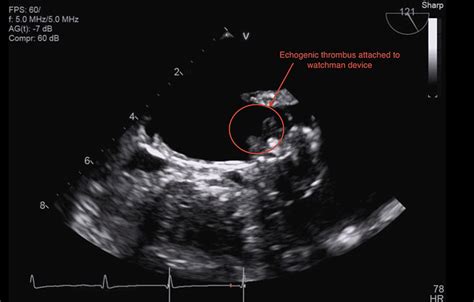 Thrombus On The Wd Circle Wd Watchman Device Download Scientific