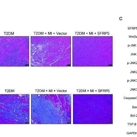 Sfrp Alleviated Myocardial Pathological Injury And Fibrosis In T Dm