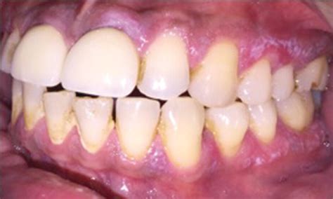 5 Gingival Examination Pocket Dentistry