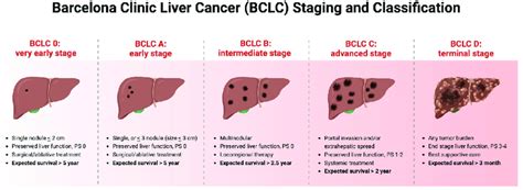 The Figure Illustrates The Bclc Staging And Classification System For