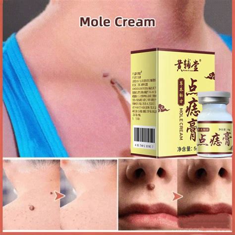 Mole Cream Skin Tag Removal Cream Tiada Tanda Buang Tidak Menyakitkan