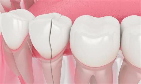 Chipped Crown