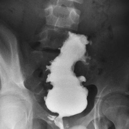 Neurogenic bladder | Radiology Reference Article | Radiopaedia.org