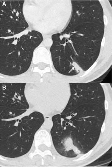 Computed Tomography Scan Of The Chest A Chest Computed Tomography