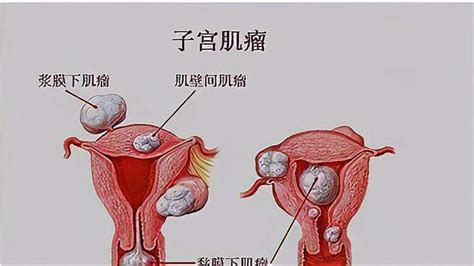 女性为什么容易长子宫肌瘤？平时尽量避免这4个不良行为 健康视频 搜狐视频