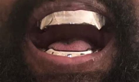 Kanye West’s $850,000 titanium teeth are ‘permanent’ and go ‘beyond ...