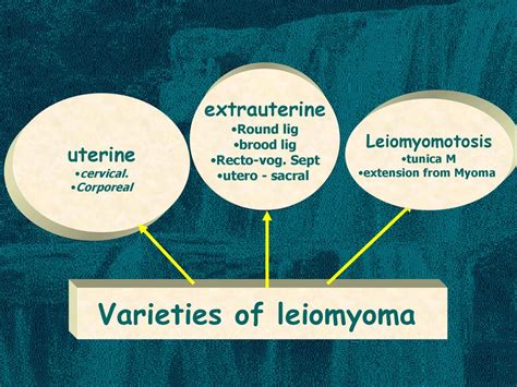 Mohammad A Emam Leiomyoma An Overview By Ppt Download