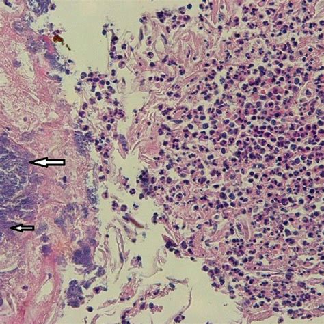 Suppurative tonsillitis-tonsillar crypt contents. The right part of the ...