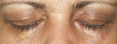 xanthelasma removal surgery