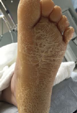 Foot Plantar Keratosis