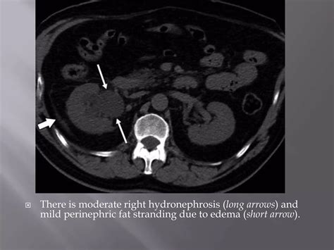 does fat stranding mean cancer 1