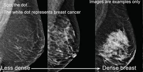 Breast Cancer Mammogram