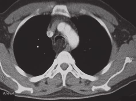 The Tumor Located In Distal Trachea Is Seen In Computerized Tomography