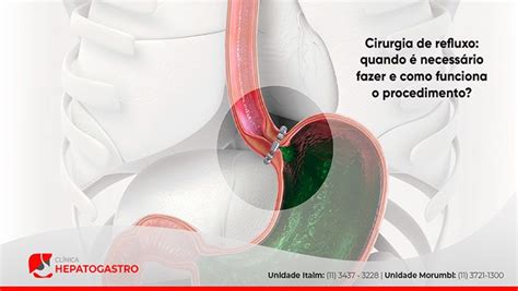 Especialistas Em Refluxo Gastroesofágico - Cirurgia De Refluxo: Quando é Necessário Fazer E Como Funciona O ...