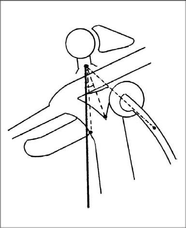mcf surgery  cochleariform process   main landmark ento key