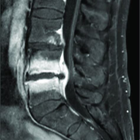 Ct Scan Of L3 L4 And L4 L5 Discs With Signs Of Degeneration And Download Scientific Diagram