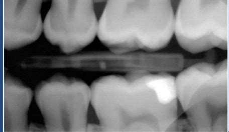 introduction  interpretation  radiolucencies flashcards quizlet