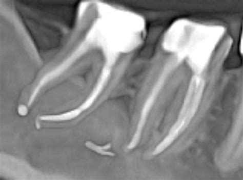 Пломбувальний матеріал за межами кореня зуба - Советчица