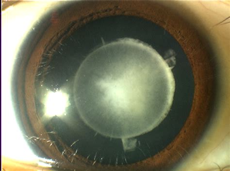 Childhood Cataract