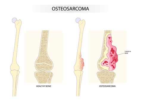 Causes Of Bone Cancer