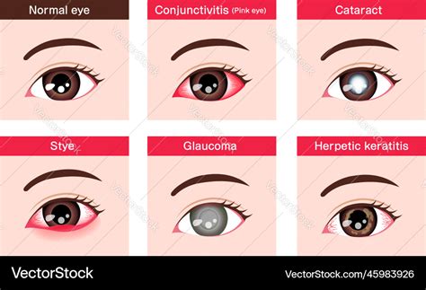 Various eye diseases female Royalty Free Vector Image