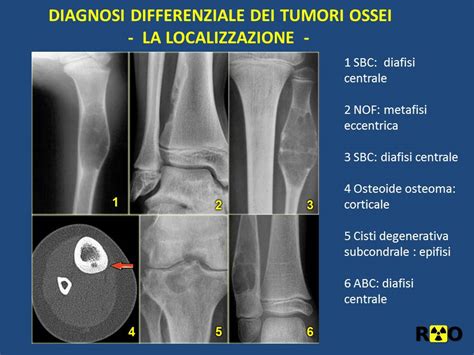 Le Lesioni Tumorali Osteolitiche Dell Osso Radiologia Ortopedica