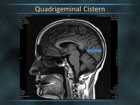 Quadrigeminal Cistern Anatomy