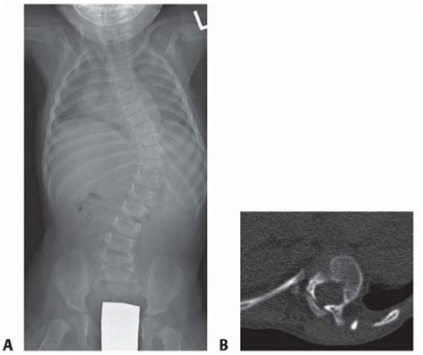 Scoliosis Body Cast