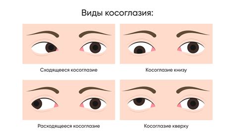 Косоглазие: Причины, симптомы и методы лечения