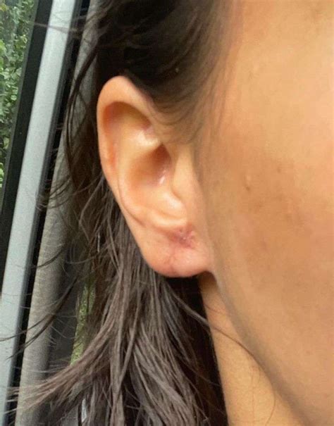 Gauged Earlobe Repair At One Month Post Op Solent Vascular Care